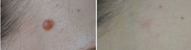 vor und nach Laser Papilloma Entfernung Foto 2