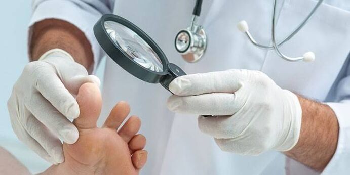 Der Arzt untersucht den Fuß eines Patienten mit einem Dorn mit einer Lupe
