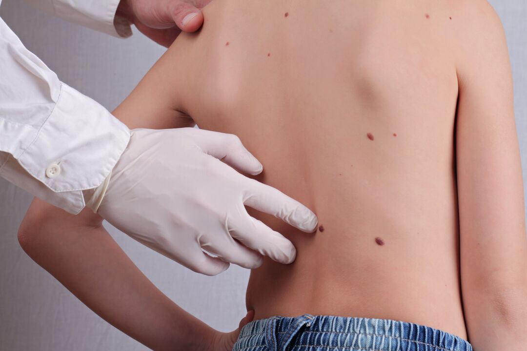 Ein Dermatologe führt eine klinische Untersuchung eines Patienten mit Papillomen am Körper durch. 