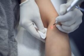 Laserbehandlung