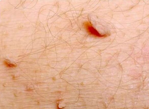 Papillome im menschlichen Körper formen