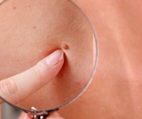 Manifestationen des menschlichen Papillomavirus