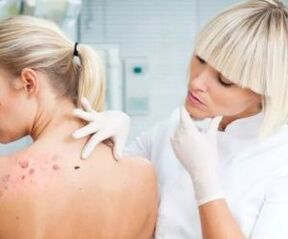 Menschliche Papillomavirus -Symptome