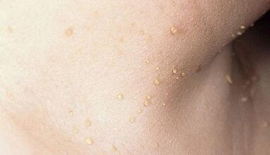 Risiko einer Papillomatose im Nacken