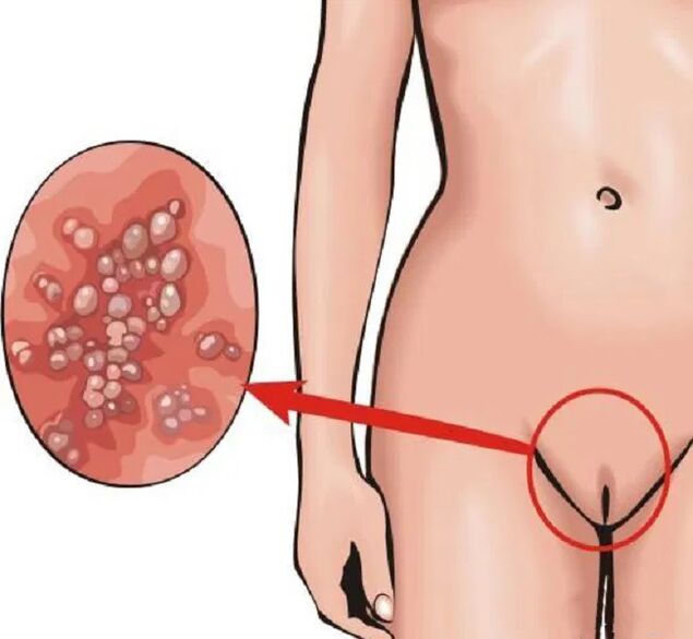 Papillome im Perineum