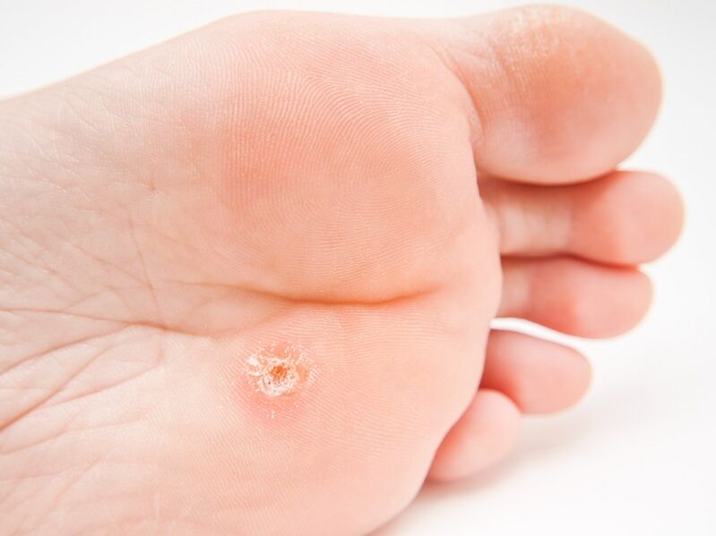 Plantarwarze am Fuß