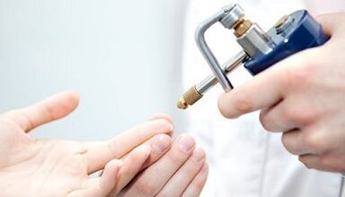 Kryodstruktur als Methode zur Behandlung von Warzen